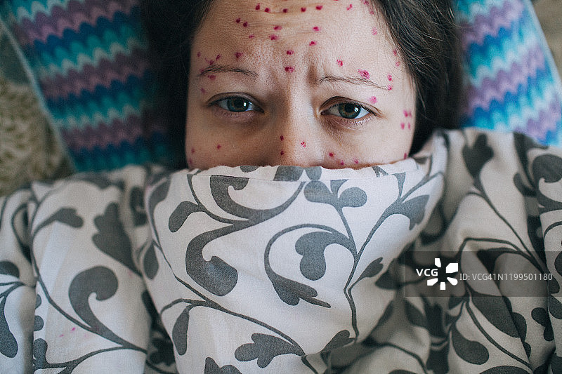 面部感染水痘的年轻女人肖像图片素材