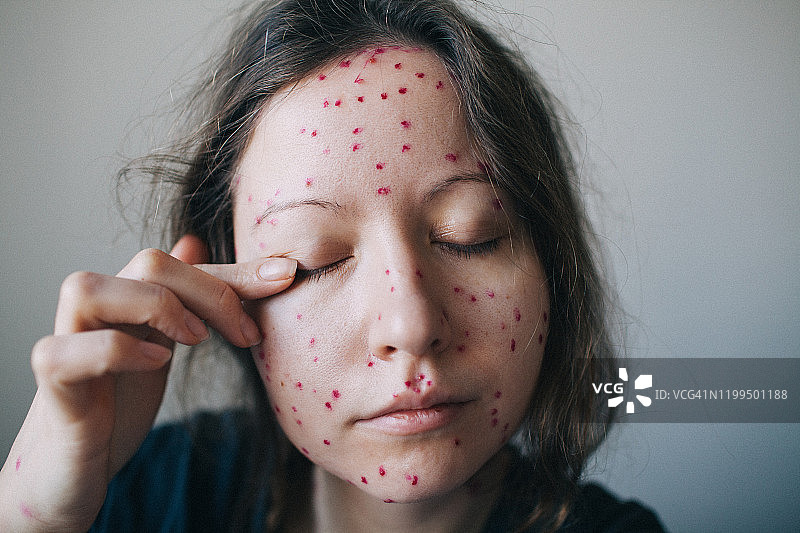 面部感染水痘揉眼睛的年轻女子肖像图片素材