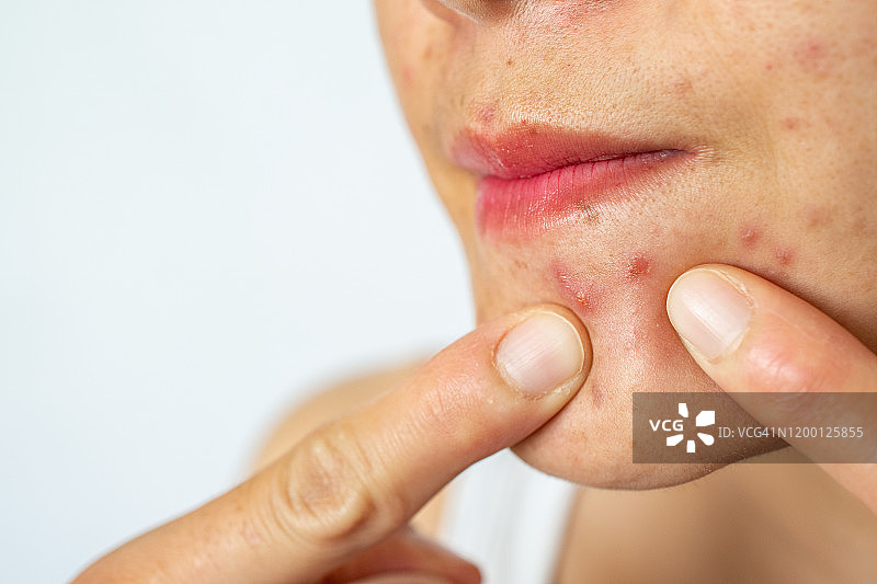 指着脸上痤疮炎症（丘疹和脓疱）的女人特写图片素材