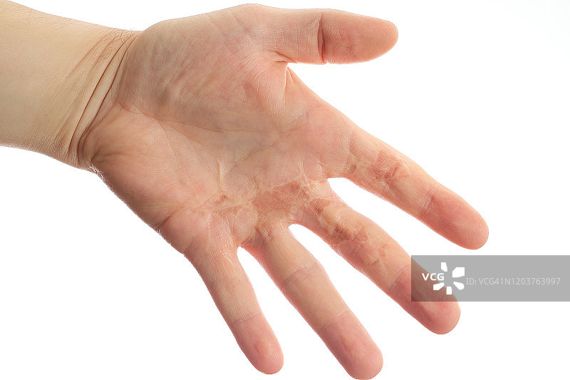 烧伤的手图片素材