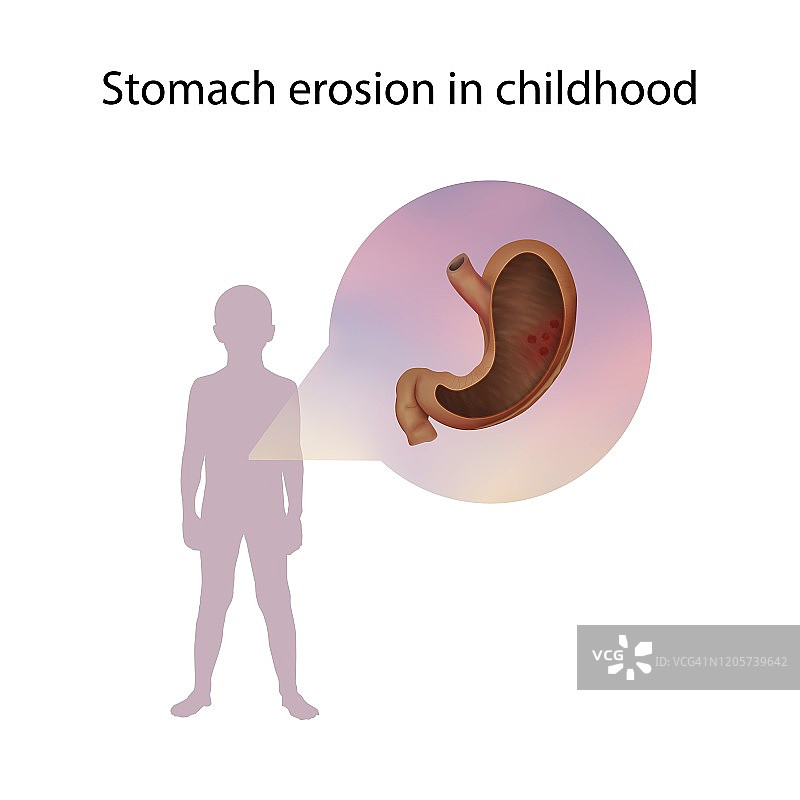 儿童时期胃糜烂插图图片素材