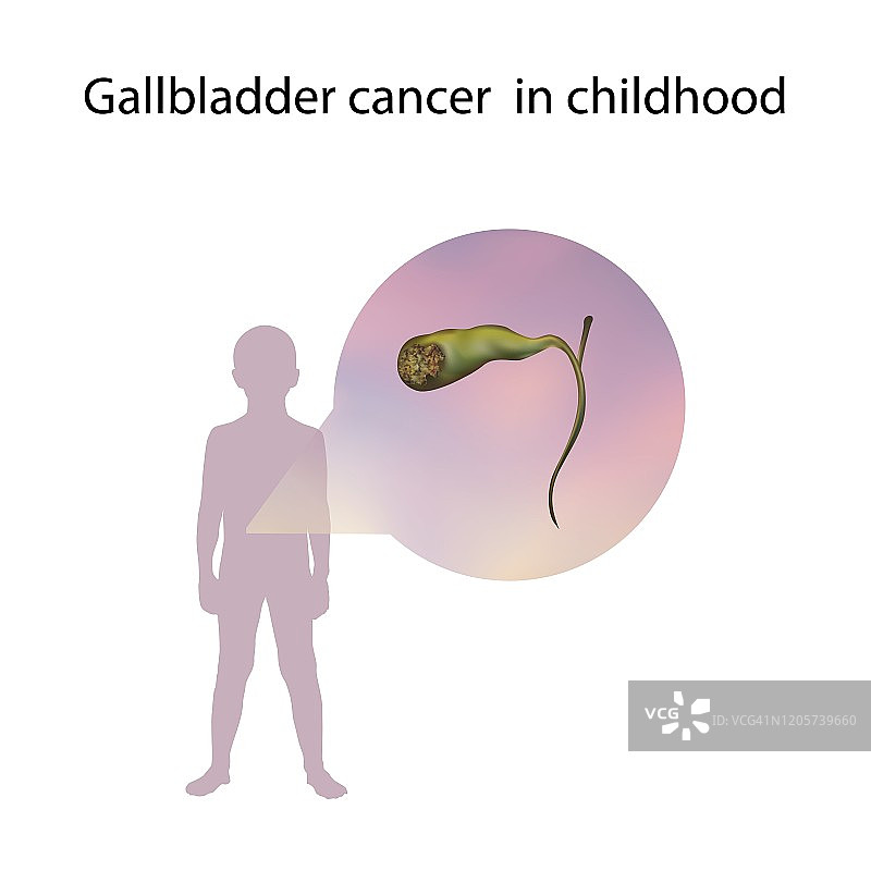 儿童胆囊癌插图图片素材