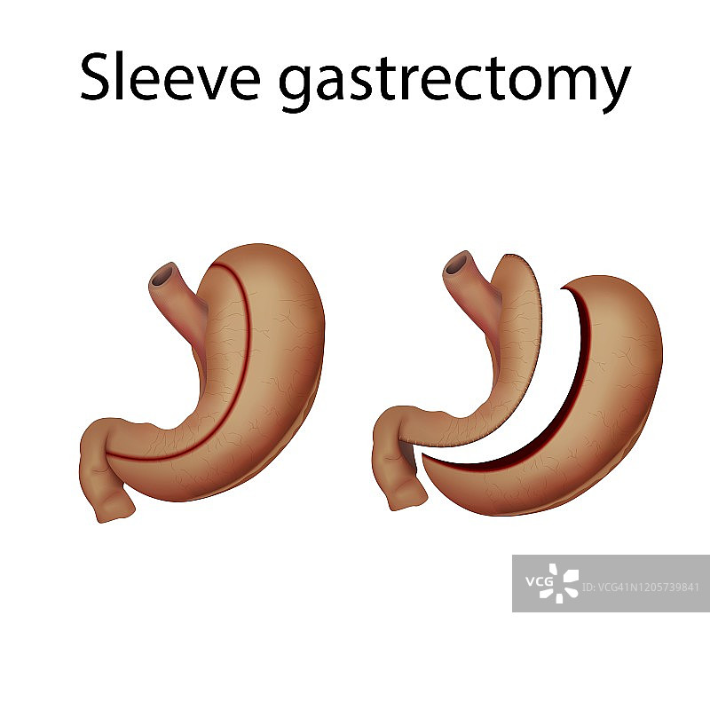 袖状胃切除术插图图片素材