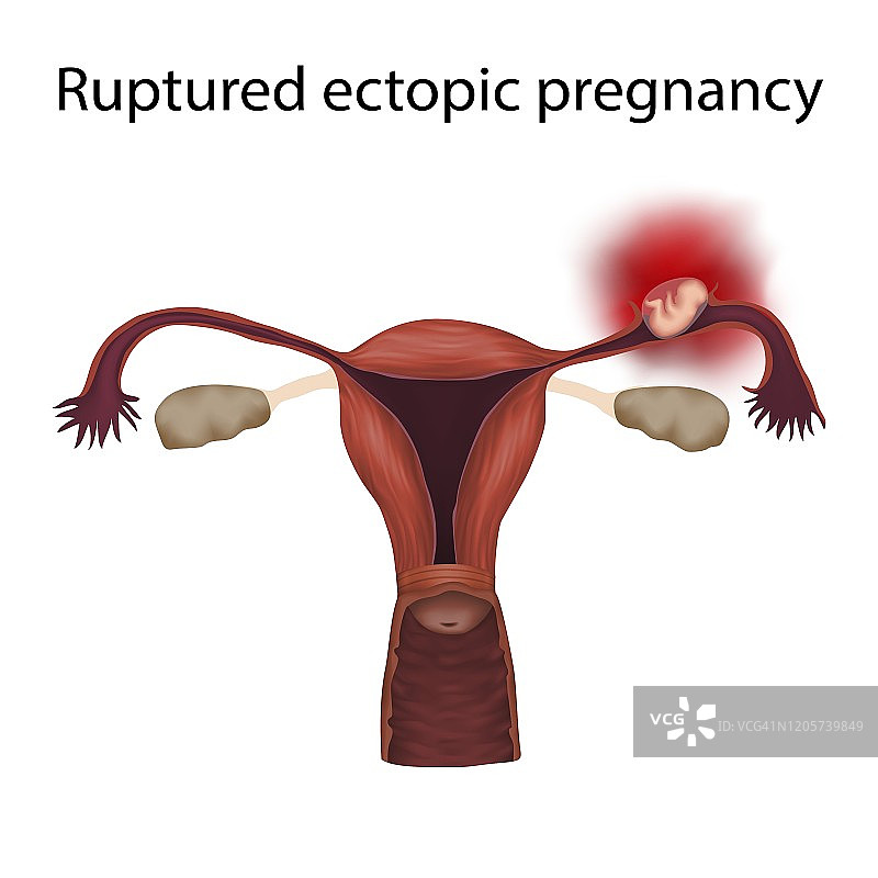 异位妊娠破裂插图图片素材