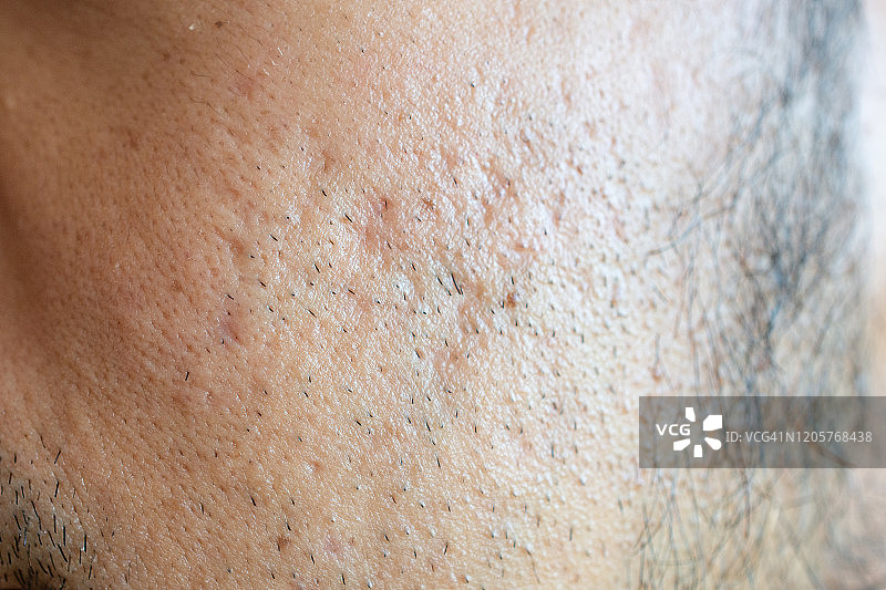 男人侧脸的皮肤问题（如痤疮、皱纹、毛孔和鱼尾纹等）特写图片素材