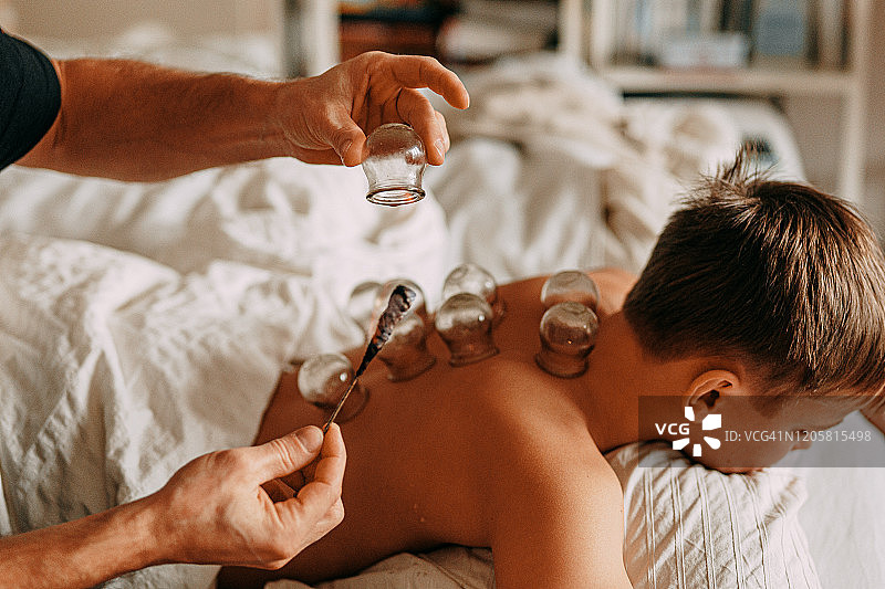 火罐疗法：年轻男孩背部的火罐图片素材