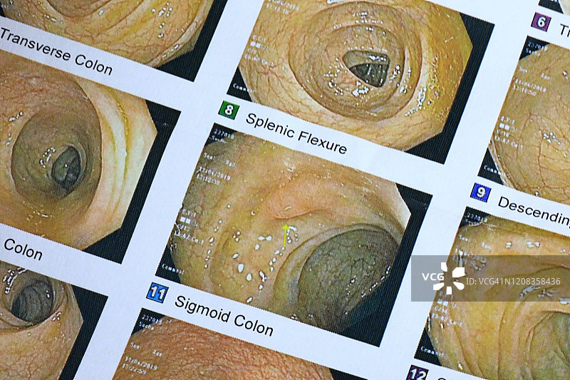 大小肠结肠镜检查影像图片素材