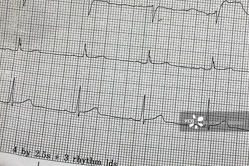 心电图上的人类心脏活动图片素材