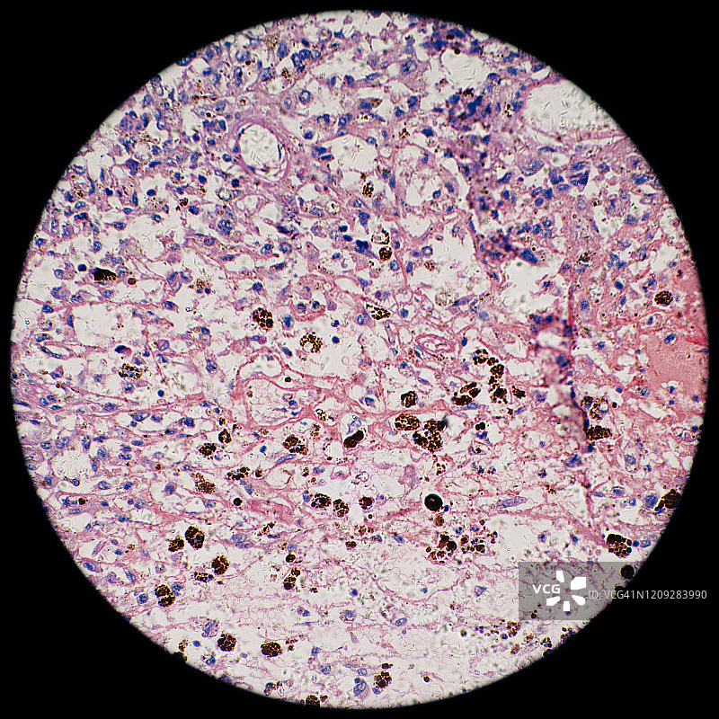 显微镜下的人体黑色素瘤癌细胞图片素材