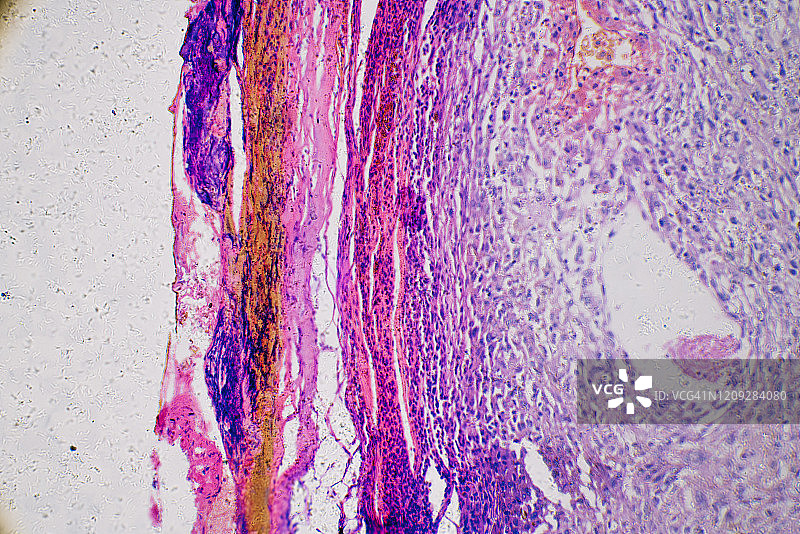 人体黑色素瘤癌细胞显微照片图片素材