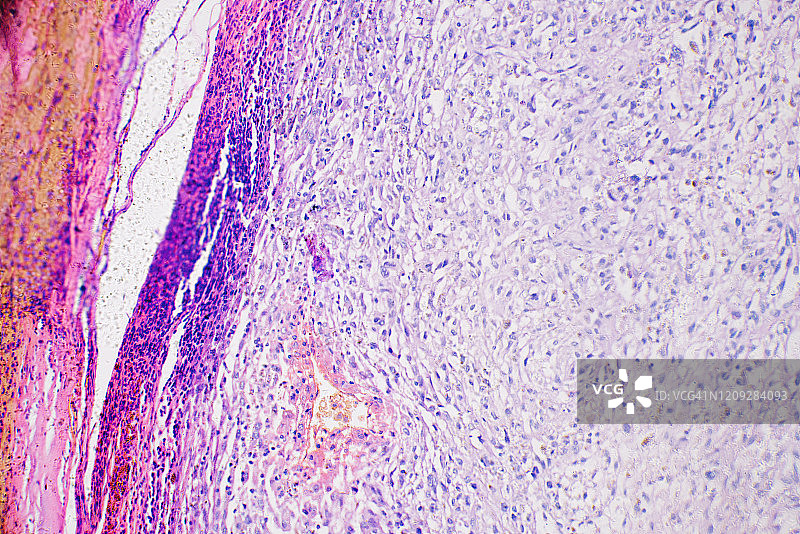 人体黑色素瘤癌细胞显微照片图片素材