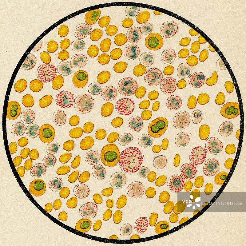 慢性粒细胞白血病患者的人类血细胞显微图，19世纪埃立希三酸染色图片素材