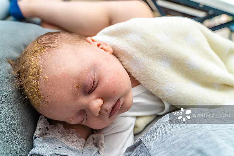 新生儿头部皮肤问题图片素材