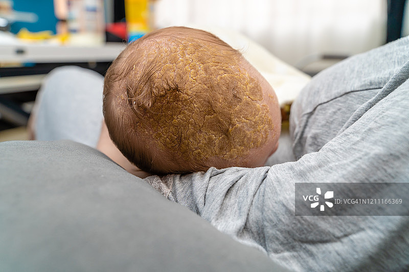 患有脂溢性皮炎的新生婴儿头部图片素材