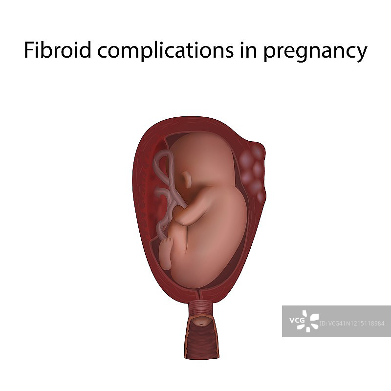 妊娠期子宫肌瘤并发症插图图片素材