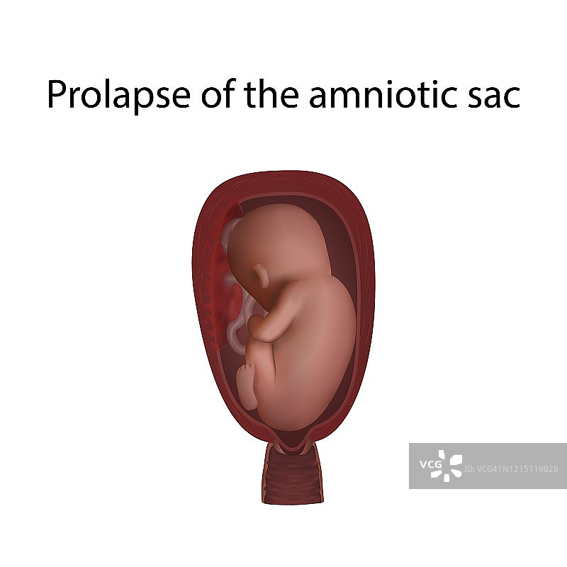 羊膜囊脱垂图片素材
