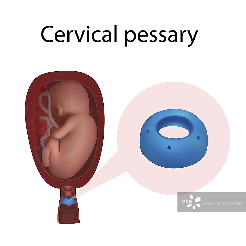 子宫颈托示意图图片素材