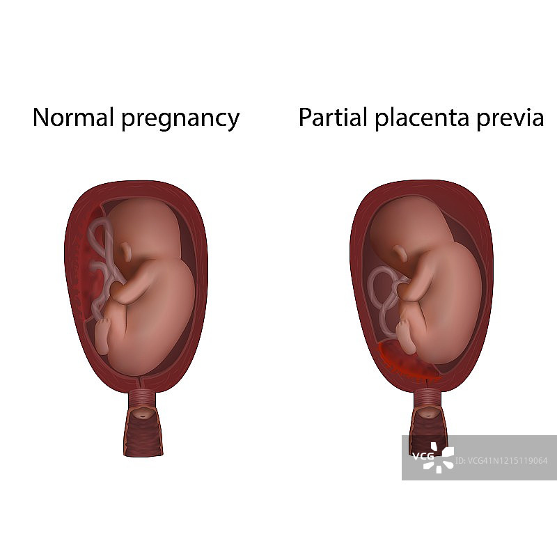 前置胎盘和正常妊娠图示图片素材