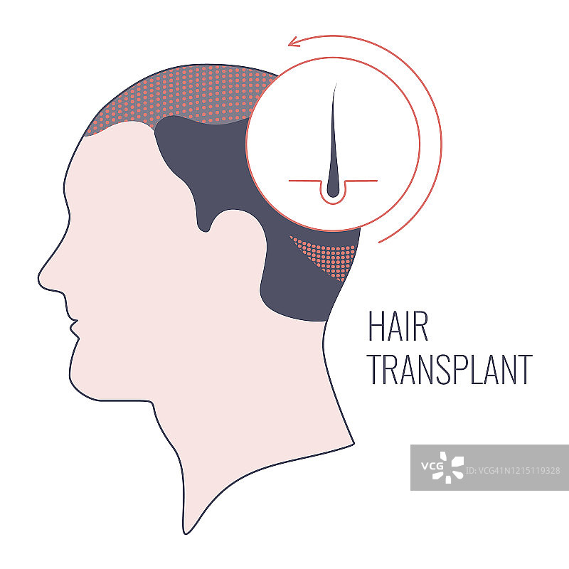 男性植发概念插图图片素材
