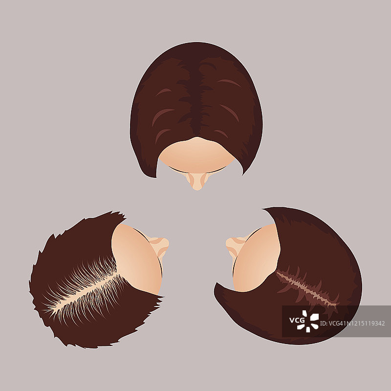 女性脱发阶段示意图图片素材