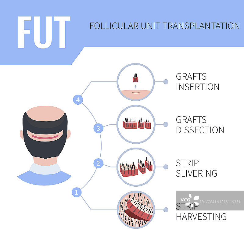 男性FUT毛发移植插图图片素材