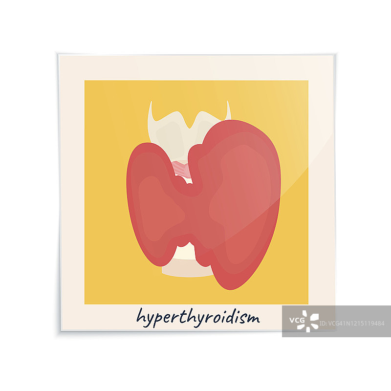 甲状腺疾病插图图片素材
