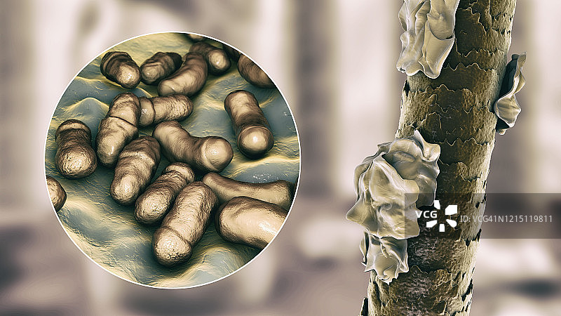 有头皮屑的人类头发插图图片素材