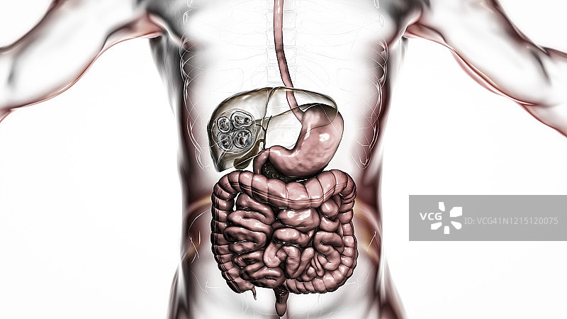 肝脏包虫病，泡型包虫病，图示图片素材