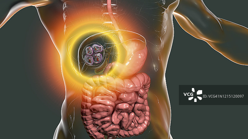 肝脏包虫病，肺泡棘球蚴病，图示图片素材