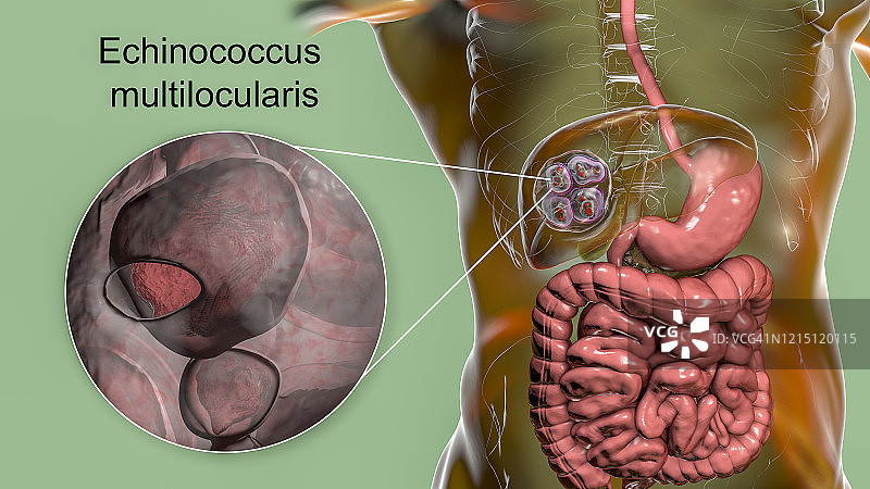 肝脏包虫病，泡型包虫病，图示图片素材