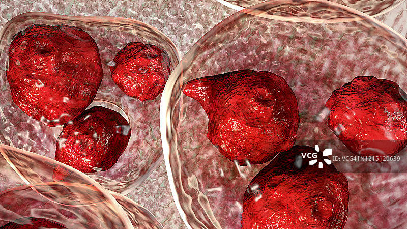 细粒棘球绦虫包虫囊肿图示图片素材