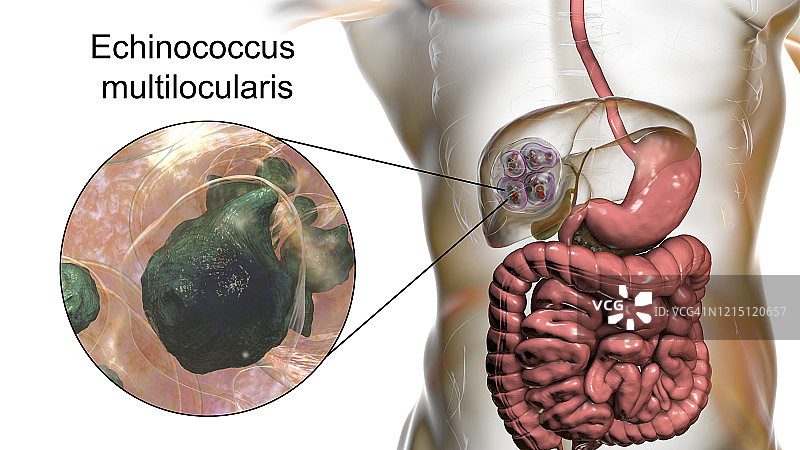 肝脏包虫病，泡型包虫病，图示图片素材