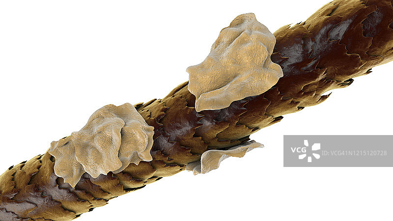 有头皮屑的人类头发插图图片素材