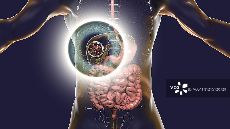 肝脏包虫病，囊性棘球蚴病图示图片素材