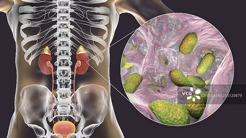 由不动杆菌引起的急性肾盂肾炎图片素材