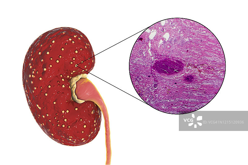 急性肾盂肾炎图示和光学显微照片图片素材