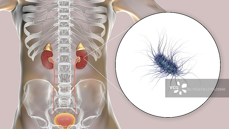 大肠杆菌引起的急性肾盂肾炎图片素材