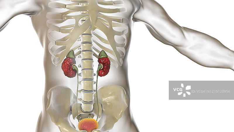 慢性肾盂肾炎插图图片素材