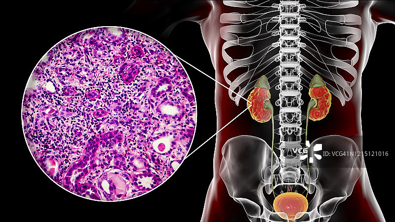 慢性肾盂肾炎，插图和光学显微照片图片素材
