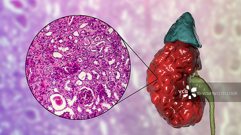 慢性肾盂肾炎，插图和光学显微照片图片素材