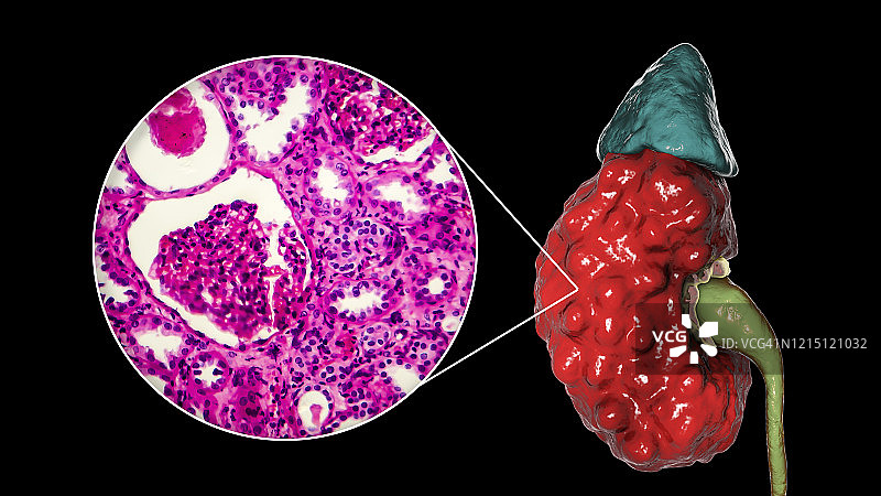 慢性肾盂肾炎，插图和光学显微照片图片素材