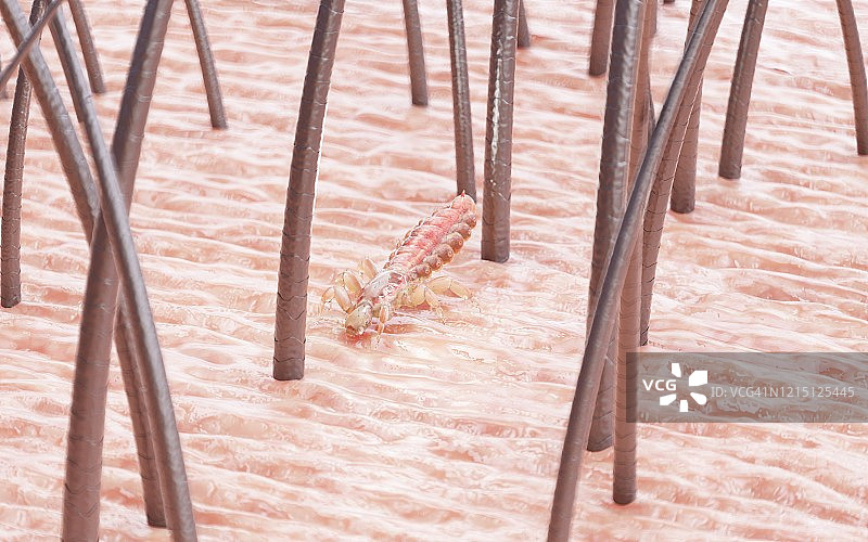 人头上的头虱插画图片素材