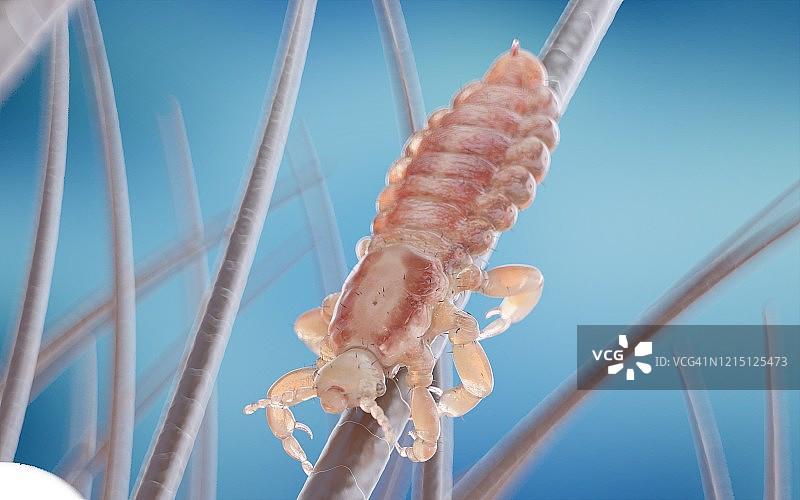 人头上的头虱插画图片素材