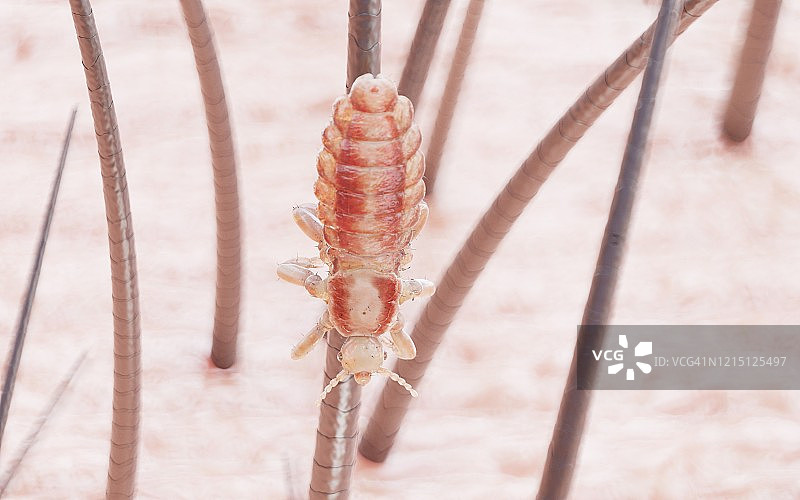 头虱插画图片素材