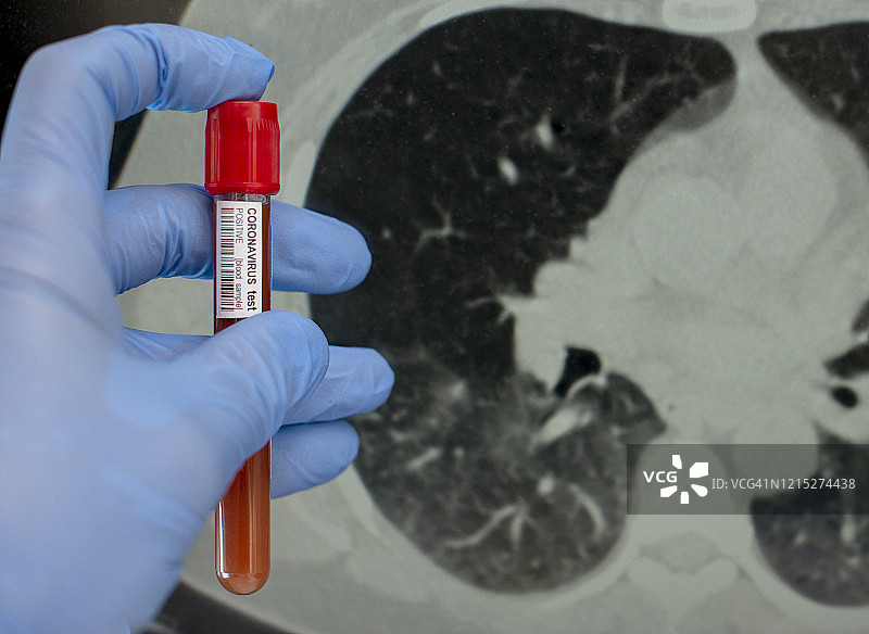 新冠病毒（COVID-19）诊断X光CAT扫描断层扫描，CT扫描毛玻璃样变图片素材