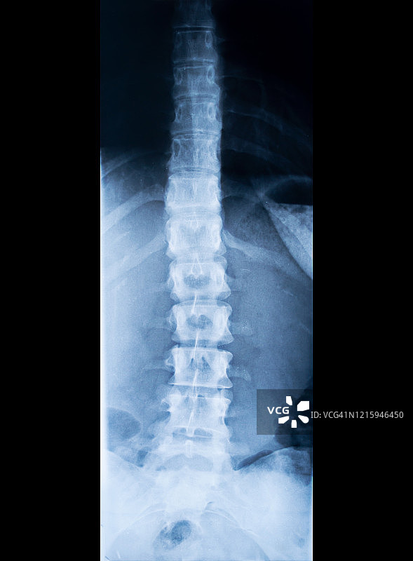 人体脊柱X光片图片素材