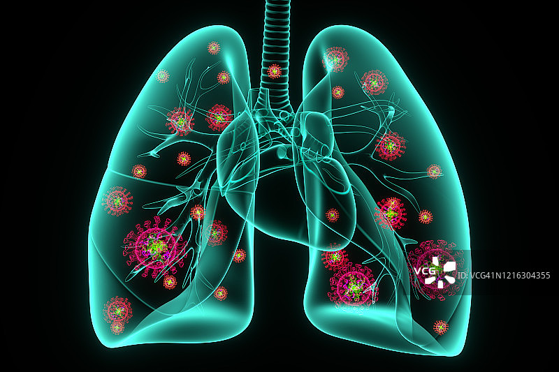 肺部的新冠病毒感染概念图图片素材