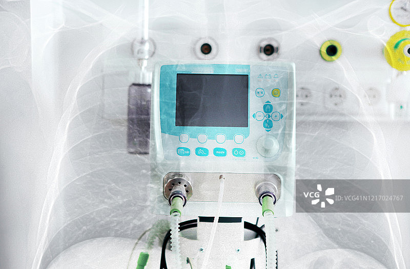 肺炎肺部X光片与ICU呼吸机的双重曝光图片素材