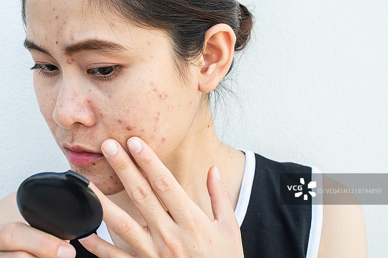 为脸上痘痘和疤痕问题发愁的亚洲女人图片素材