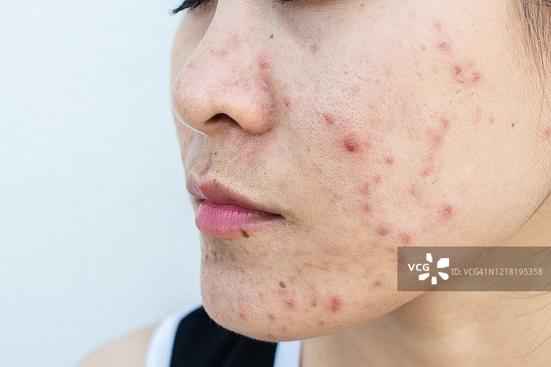 女人面部有各种皮肤问题（如痤疮、粉刺、毛孔和黄褐斑等）的特写镜头图片素材